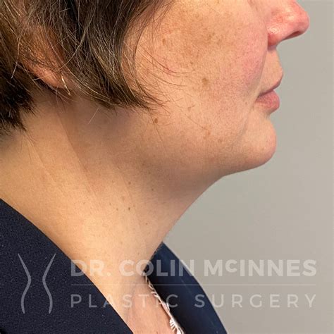 Face And Neck Lift Procedure Dr Colin Mcinnes