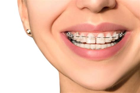 Braces How They Work And Care In 2020 Orthodontics Orthodontist Best