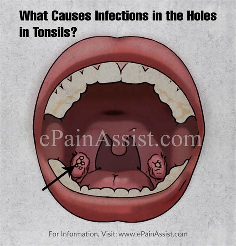 What Causes Infections In The Holes In Tonsils And How Is It Treated