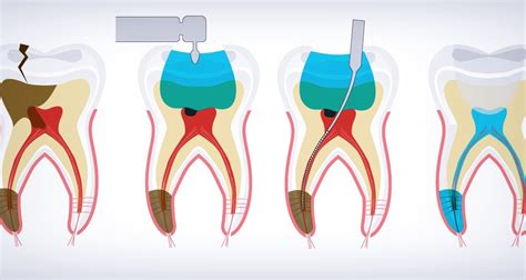 Inflamación De La Pulpa Dental