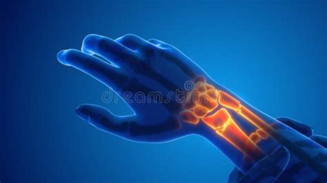 Broken Wrist Bone Pain Medical Concept Stock Illustration