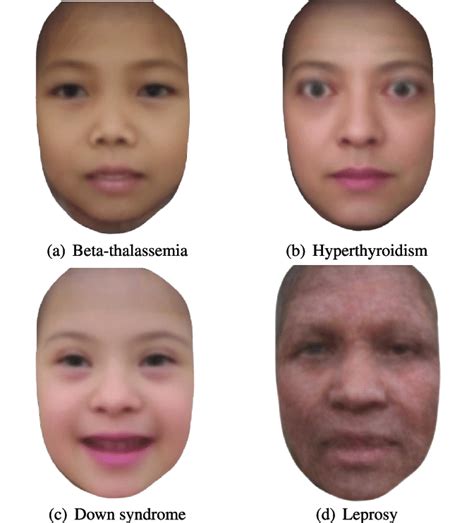 Disease Specific Faces Download Scientific Diagram