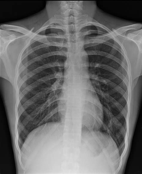 Rib Fracture On Ultrasound Image Radiopaedia Org