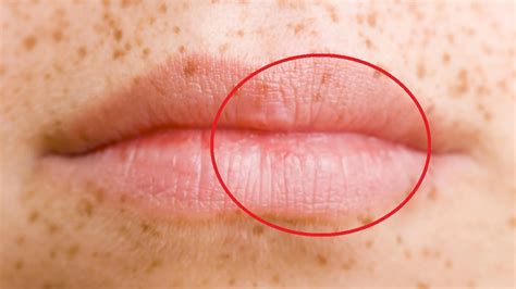 How To Get Rid Of Freckles On Lips Youtube