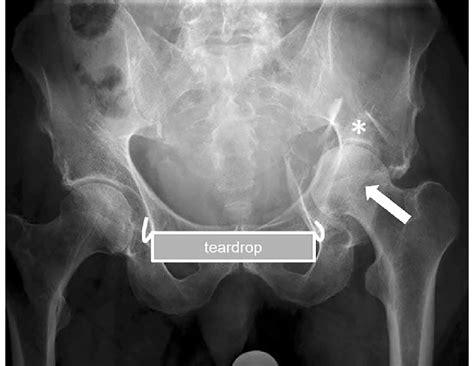 Preoperative Anteroposterior Radiograph Of The Pelvis Showing An