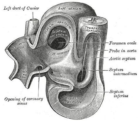 Foramen Ovale Atrial Septal Defect In A Heartbeat Dream Body