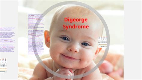 Digeorge Syndrome By Jonry Solis