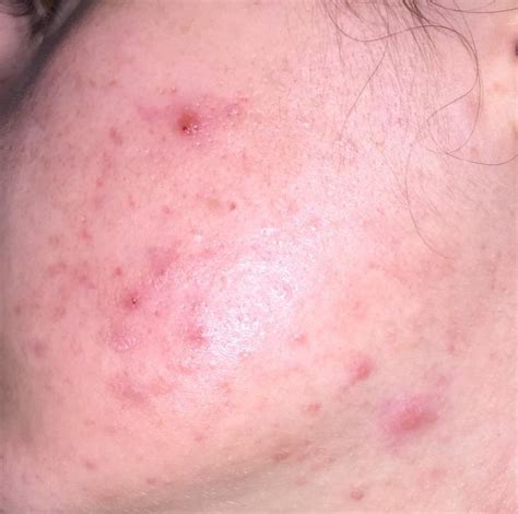 What Kind Of Acne Is This Wont Respond To Treatments Picture