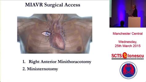 Mini Avr Right Anterior Thoracotomy Youtube