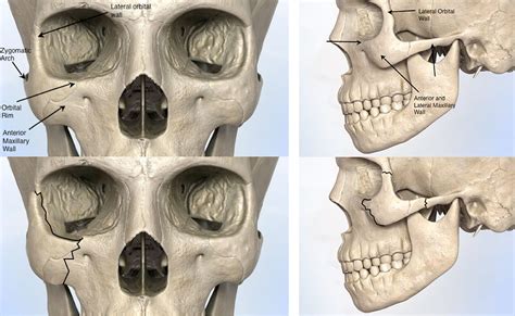 Cheek Fracture Facial Trauma