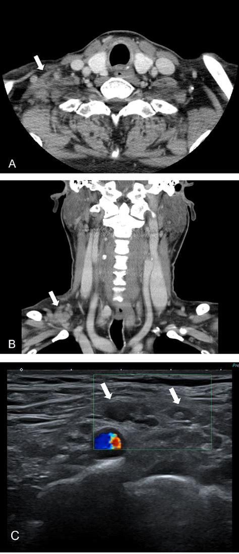 Figure 1 From Rare Case Of Contralateral Supraclavicular