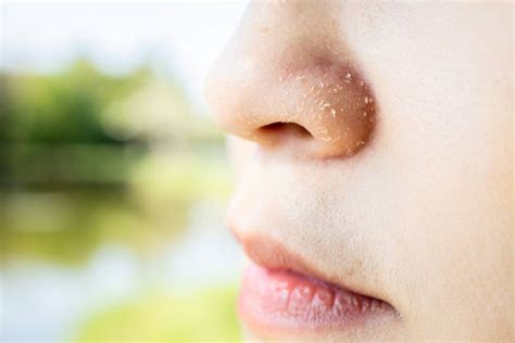 Dermatitis Seborreica En La Cara Causas Y Tratamientos Skinexpert