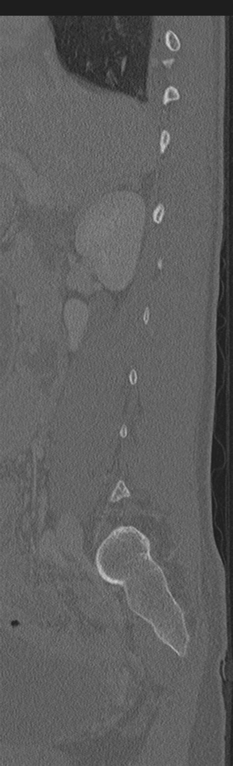 Fileabdominal Multi Trauma Devascularised Kidney And Liver Spleen