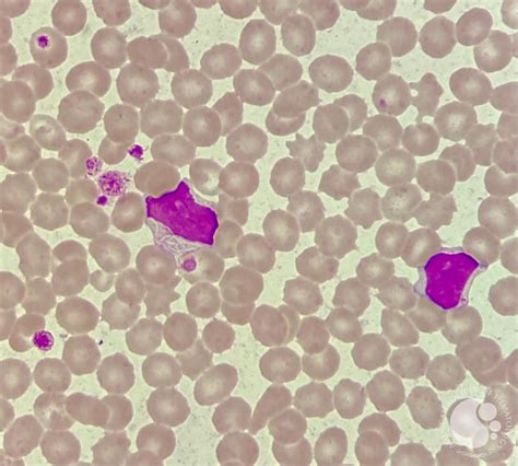 Cll With Intracytoplasmic Inclusions 2