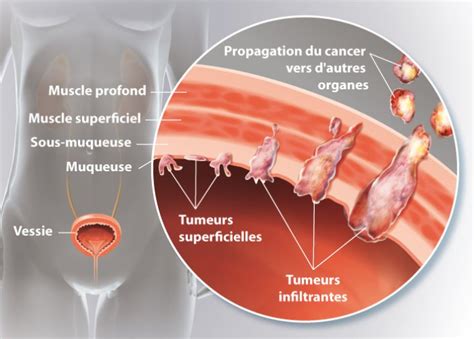 Les Tumeurs De Vessie Expliqu Es Par Le Docteur Adjiman