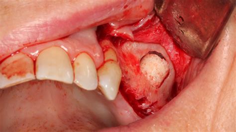 Sinus Lift Grafting Surgery Dental Implants Vancouver