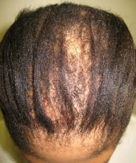 Use your hands instead of a brush when hair is dry. A Relaxer To Deal With Central Cetrifugal Cicatrical Alopecia? - Black Hair Information