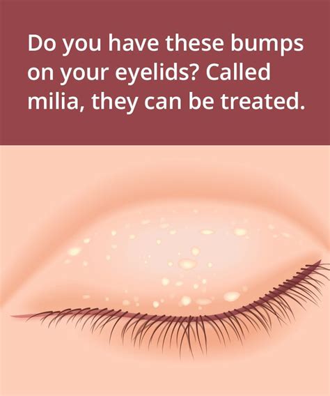 How To Get Rid Of Milia Tiny Bumps On Eyelids White Bump On Eyelid