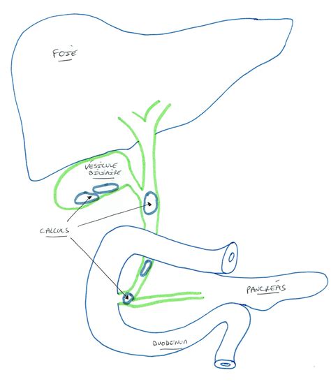 Lithiase De La Voie Biliaire Principale Pdf