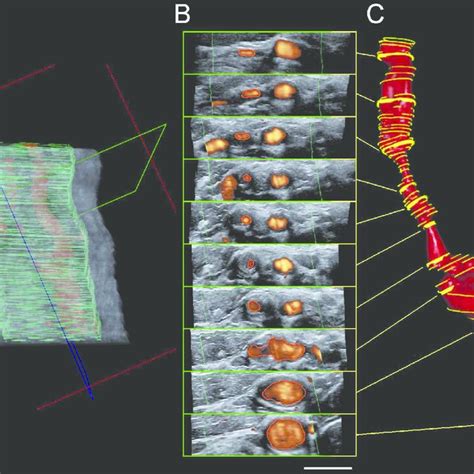 Three Dimensional Ultrasound 3dus Vessel Reconstruction A