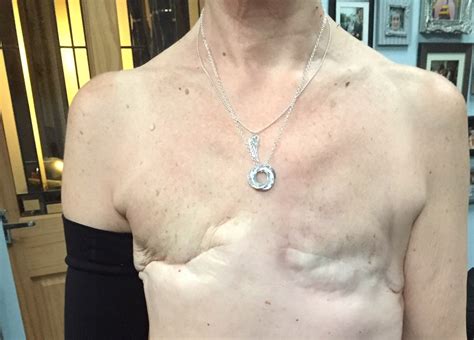 5 Years After Remission Woman Gets Mastectomy Tattoo On Her Chest