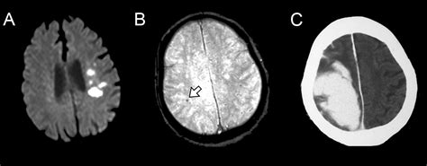 Risk Of Intracerebral Hemorrhage In Patients With Cerebral Microbleeds