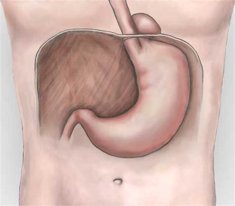 Type 1 hiatus hernia on retroflexion with fundic gland polyps.jpg 1,350 × 1,080; Can You Show Me Some Pictures of Hiatal Hernia? - HTQ