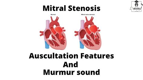 Mitral Stenosis Auscultation Features And Murmur Sound Description Youtube