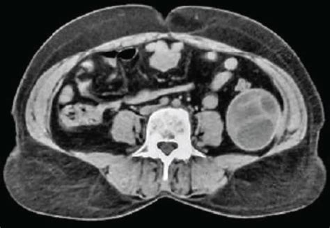 Ct Scan Of The Abdomen Showing Giant Multiloculated Hydatid Cyst With