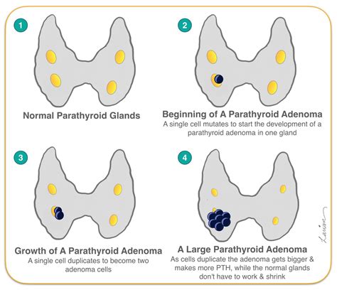 Parathyroid Adenoma Growth Progression Hyperparathyroidism Surgery