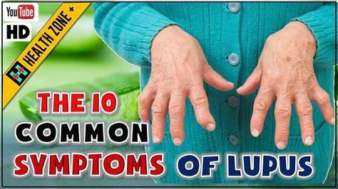 The 10 Common Symptoms Of Lupus Youtube