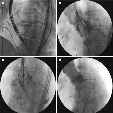 Current And Next Generation Of Transcatheter Valves Thoracic Key