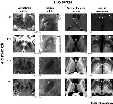 Ultra High Field Mri Guided Deep Brain Stimulation Trends In Biotechnology
