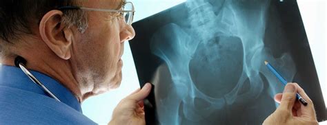 Osteoporosis What You Need To Know As You Age Johns Hopkins Medicine