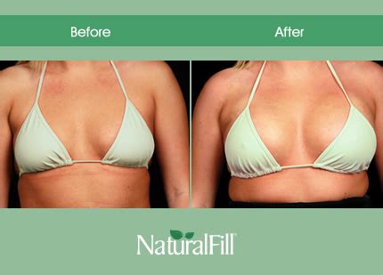 Breast Augmentation Fat Transfer Pros Cons Liposuction Manly Sydney Average Cost Of Breast