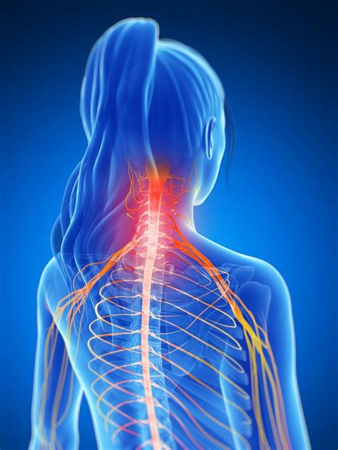 Cervical Radiculopathy Treatment Allspine