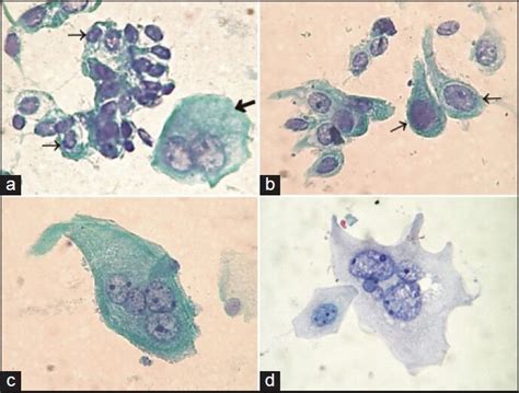 Cytology Of The Urinary Tract A Normal Urothelial Cells A Group Of