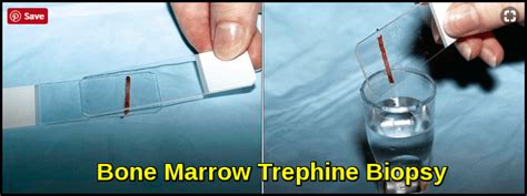 Bone Marrow Biopsy Sample