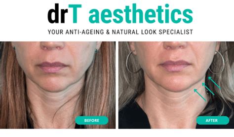 Dr Ts Top Treatments For Getting Rid Of Sagging Jowls Dr T Aesthetics