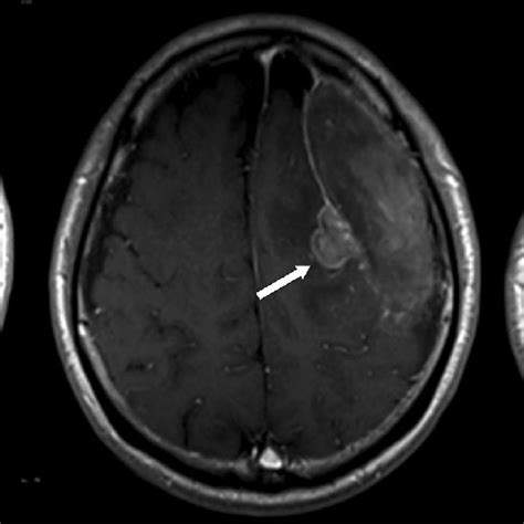 T1 Weighted Post Gadolinium Mr Image Shows The Extra Axial Polypoidal