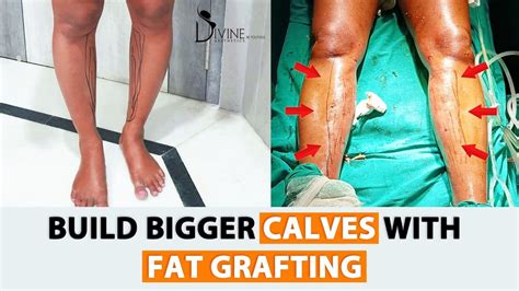 Build Bigger Calves With Fat Grafting Calf Fat Injection Calf Fat