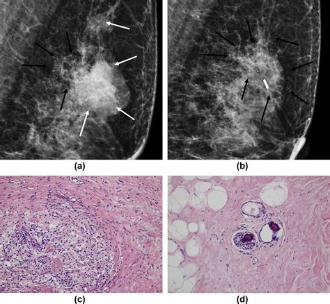 Preoperative Evaluation Of Mammographic Microcalcifications After Neoadjuvant Chemotherapy For