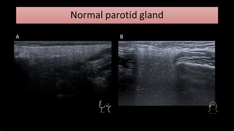Parotid Abscess Ultrasound