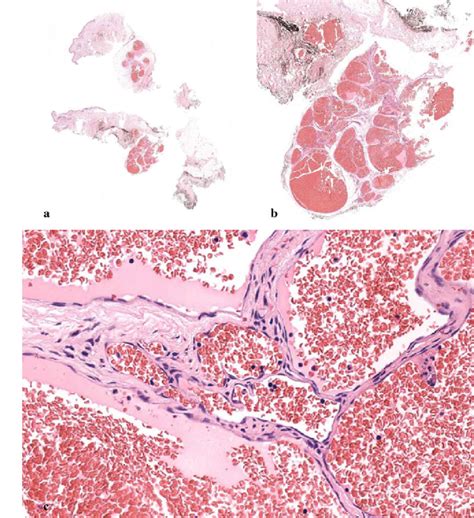 A Cavernous Hemangioma Circumscribed Vascular Proliferation Located In