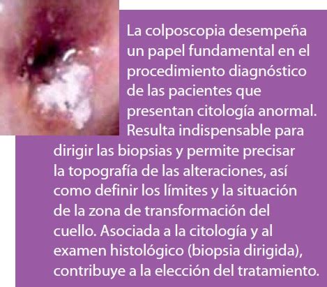 Infección por virus del papiloma humano