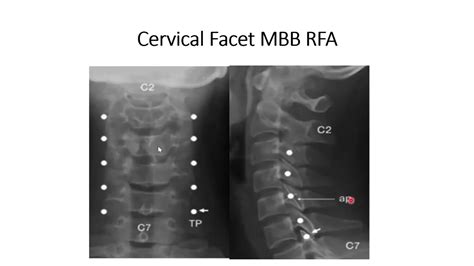 Cervical Facet Joint Median Branch Radiofrequency Ablation A