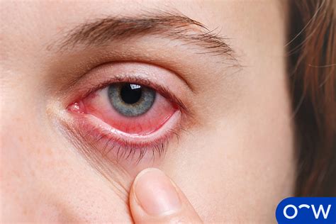 Eye Pain Definition Causes Prevention And Treatment