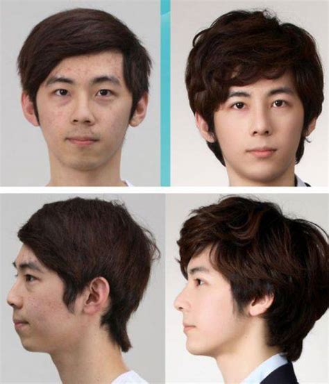 Before And After Photos Of Korean Plastic Surgery Pics Izismile