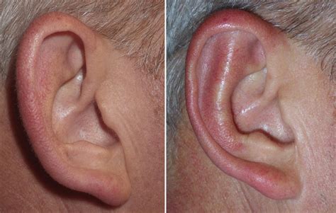 Otoplasty And Protruding Ears Richmond Va Ear Surgery Richmond