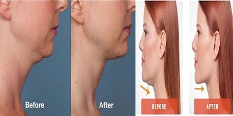 how to get rid of double chin fast with face massage 💆 neck fat reduction without surgery the